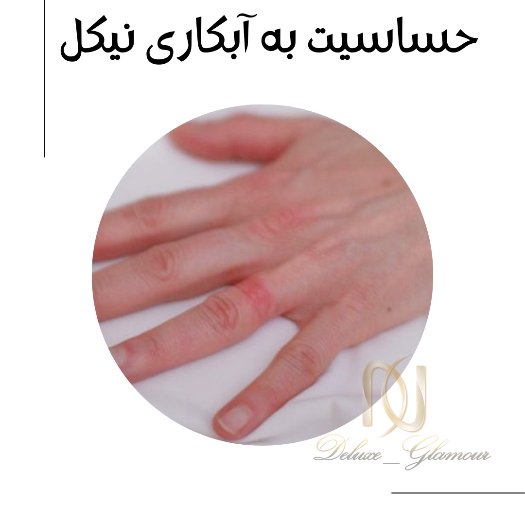 حساسیت به آبکاری نیکل